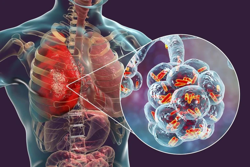 ALS Czech Republic: Legionella a respirační onemocnění