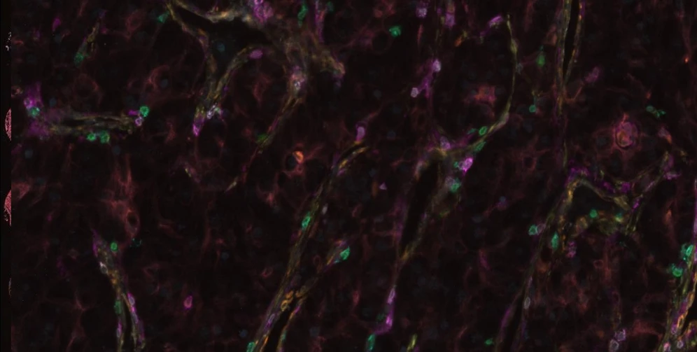 Pragolab: Kidney Clear Cell Carcinoma