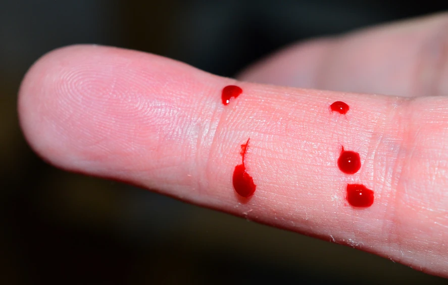 Pixabay/sipa: How state-of-the-art mass spectrometry can improve dried blood spot analyses