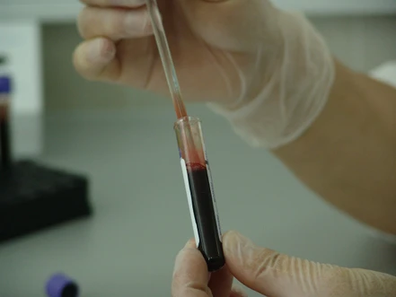 V Pardubicích vyvíjejí metodu včasného odhalení nejzákeřnějšího druhu rakoviny