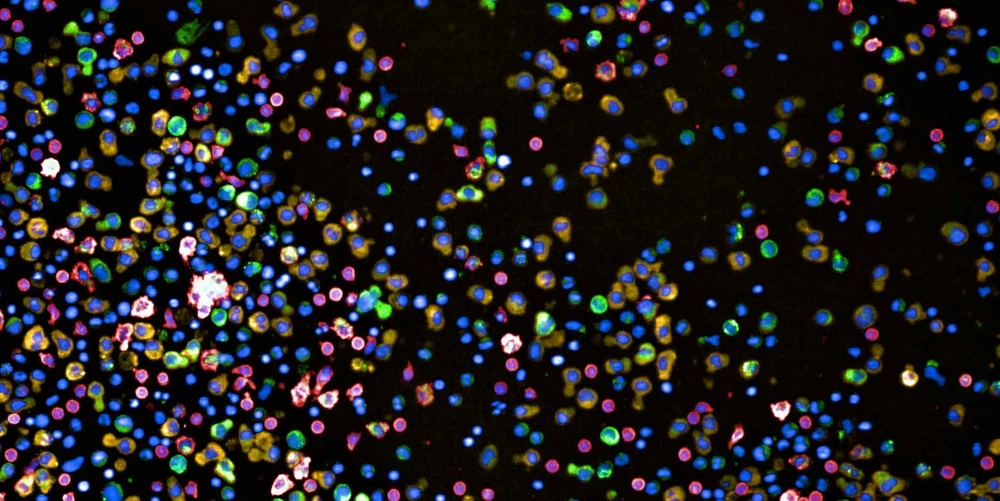 <ul>
<li><strong>Photo:</strong> ETH Zurich / Berend Snijder Lab: Bone-marrow cells of a multiple myeloma patient. Red cells are healthy monocytes, green and yellow are plasma cells.</li>
</ul>
