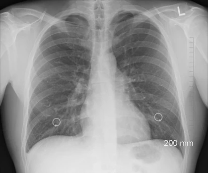 GC×GC-HR-TOFMS for untargeted screening of Breathomics